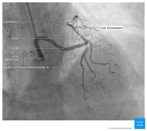 Abnormal Left Coronal Artery Case And Images Kenhub