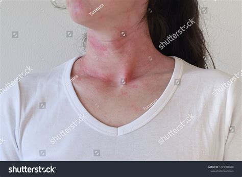 Allergic Reaction Images Stock Photos And Vectors Shutterstock