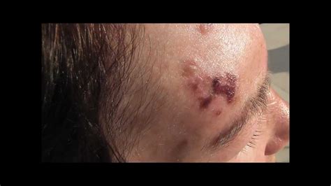 Shingles Herpes Zoster On A Patients Forehead Before And During