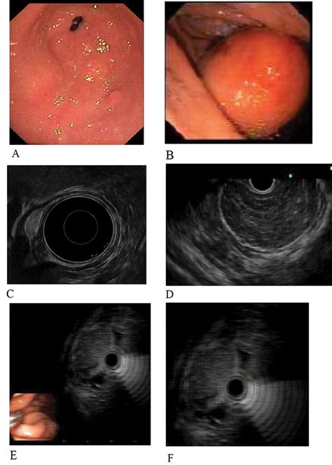 Role Of Endoscopic Ultrasound In Subepithelial Lesions Sels Intechopen