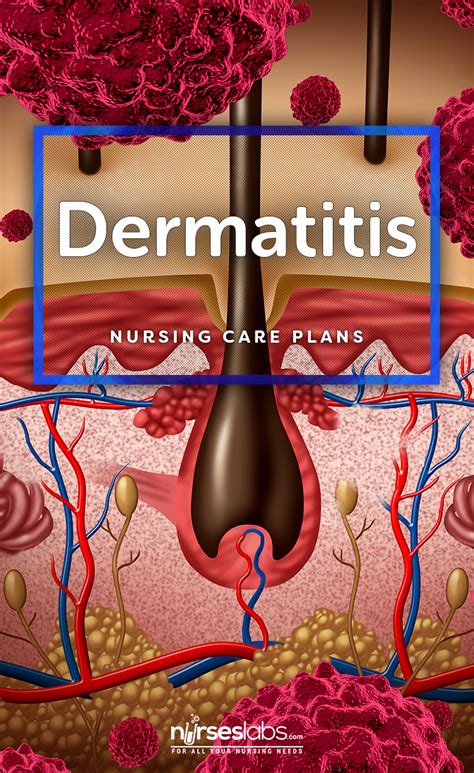 4 Dermatitis Nursing Care Plans Nursing Care Plan Nursing Care