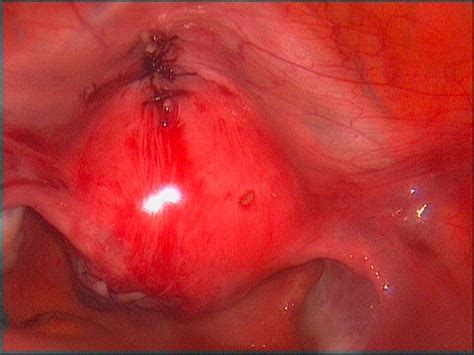 Das ligamentum teres (runde band) hält die gebärmutter nach vorne abgeknickt. Themen rund um die Gynäkologie - GYNCOLLEGWESERLAND
