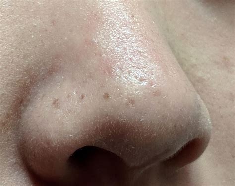 Brown Concerns Hormonal Nose Remove Skin Spots Skin Concerns