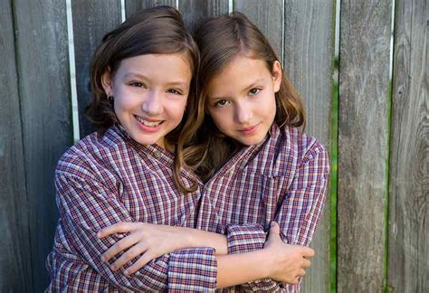 Conjoined Twins Types Causes Signs Treatment