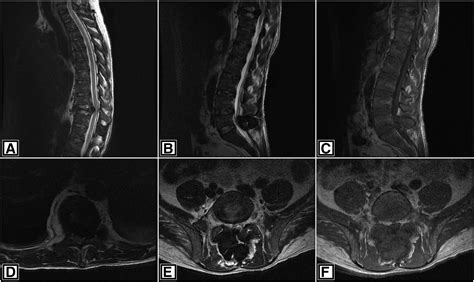 Imaging Findings Of Spinal Brown Tumors A Rare But Important Cause Of