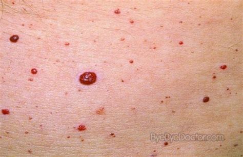 Cherry Angioma Identification Causes And Treatments — Info You Should Know