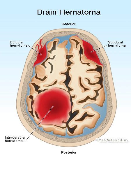 How To Spot A Stroke Brain Hemorrhage Medical Anatomy Brain Anatomy