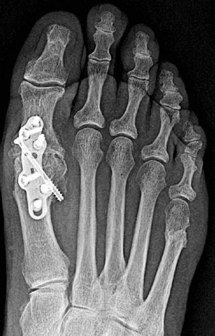 Surgical Correction Of Hallux Limitus Big Toe Joint Arthritis Central Massachusetts Podiatry