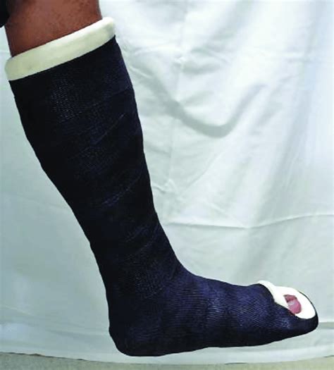 Management Of Toe Fractures Sports Medicine Review