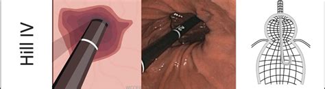 Hiatus Hernias And The Hill Classification Endoscopy Campus