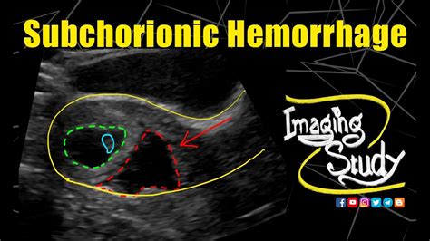 Subchorionic Hemorrhage Ultrasound Case 258 Youtube