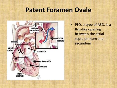 Pfo Closure