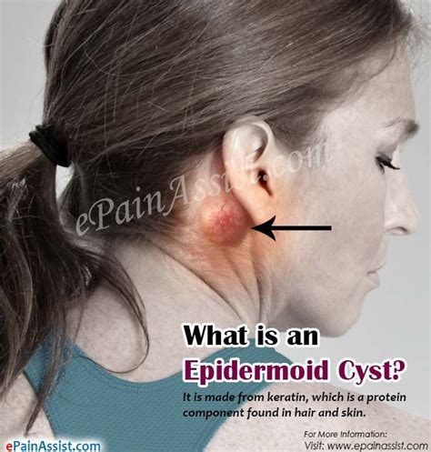 What Is An Epidermoid Cyst Epidermoid Cyst Fatty Cyst Ear Infection