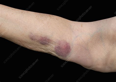 Bruised Arm Stock Image C0500879 Science Photo Library
