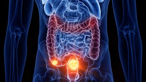 5 Little Known Colon Cancer Symptoms To Look Out For