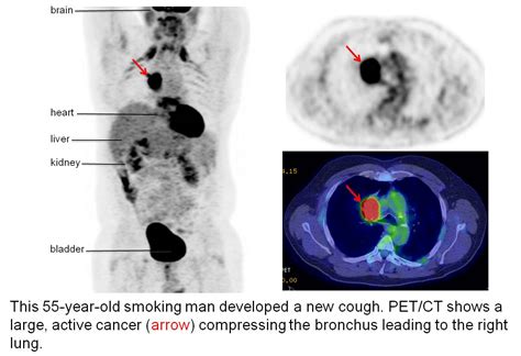 How Does Cancer Appear On A Pet Scan Petswall