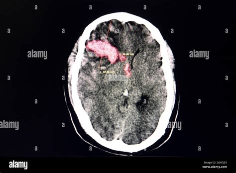 Hemorragia Cerebral Cerebro Fotograf As E Im Genes De Alta Resoluci N