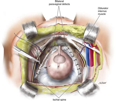 Surgical Management Of Anterior Vaginal Wall Prolapse Abdominal Key