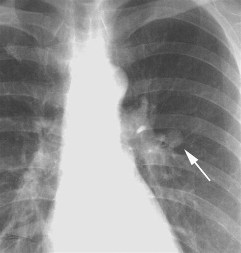 bronchial carcinoid tumors of the thorax spectrum of radiologic findings radiographics