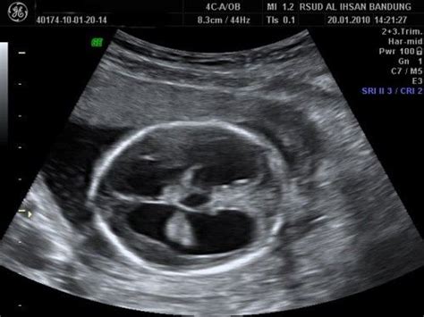 Hydrocephalus Image 1 Dilated All Ventricle Obgynnet Ultrasound