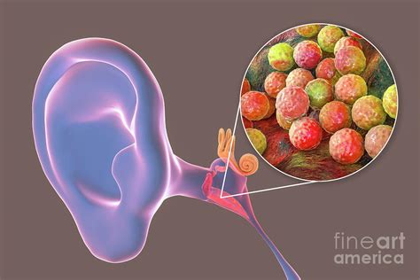 Otitis Media Ear Infection Photograph By Kateryna Konscience Photo