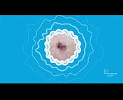 skin cancer signs the abcdes of melanoma video dailymotion