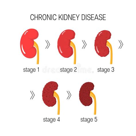 Chronic Kidney Disease Vector Stock Vector Illustration Of Cartoon