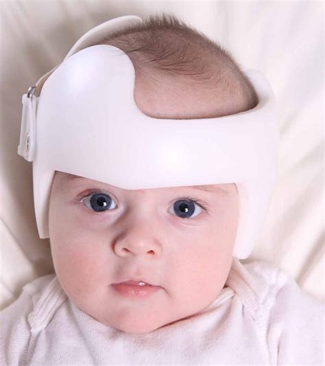 Baby Flat Head Syndrome Plagiocephaly Causes And Treatment
