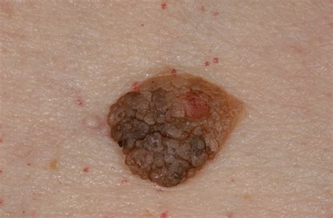 Seborrheic Keratosis Pictures Complications And Treatment