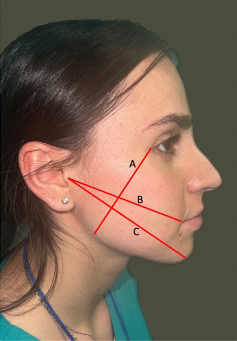 Edema Assessment Methodology Line A From The External Canthus To The