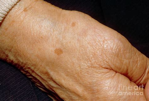 Liver Spots On The Hand Of An Elderly Woman Photograph By Jane Shemilt