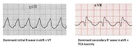 The Daily Educational Pearl VT Vs SVT With Aberrancy Emergucate