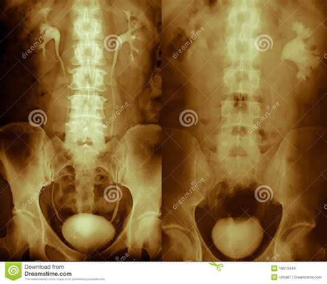 Ct Scan 3d Ct Urography Kidneys Bladder Colorful Royalty Free Stock