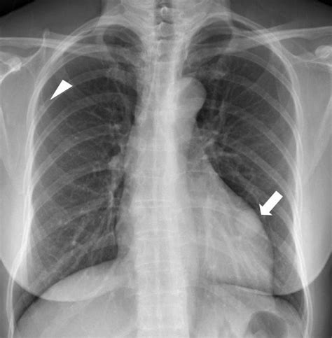 Chest Radiograph There Is A 26 Cm Well Defined Oval Mass In The Left