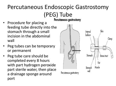 Gastric Tubes