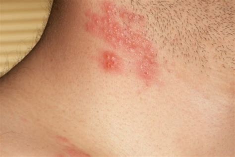 Different Type Of Skin Rashes Healthy Living