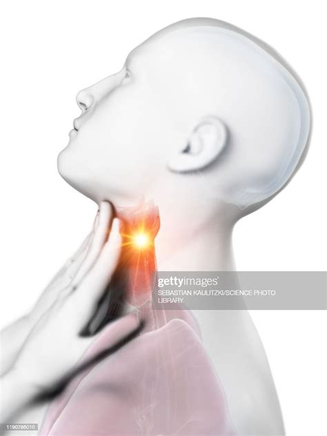 Sore Throat Conceptual Illustration High Res Vector Graphic Getty Images