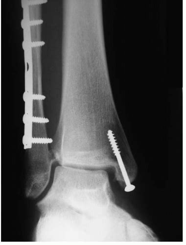Ankle Fracture Malunion And Late Syndesmosis Reconstruction