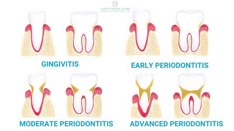 Stages Of Periodontal Disease How Gum Disease Is Treated