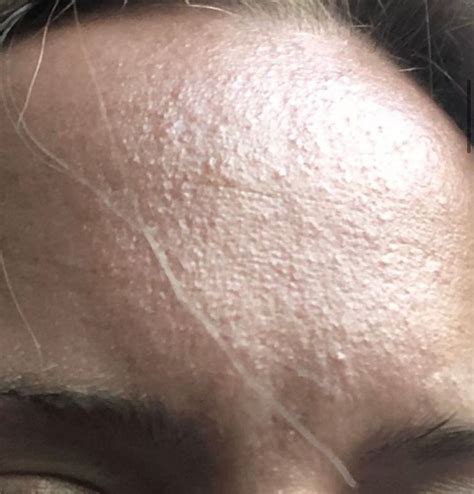 Re Tiny Bumps On Forehead Beauty Insider Community