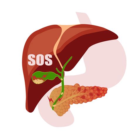 Illustration Showing Inflamed Pancreas Gallstones Blocking Pancreatic