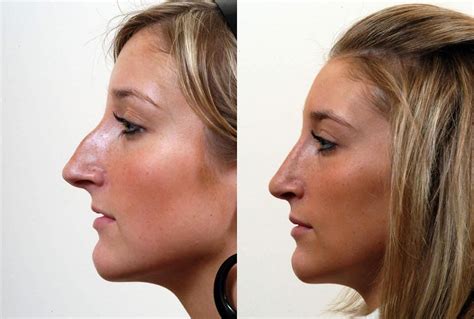 Operacja Plastyczna Nosa Przed I Po Operacji Chirurgia Plastyczna Dr My Xxx Hot Girl