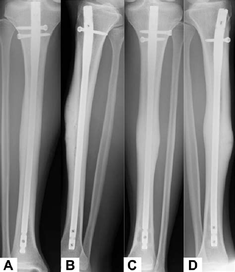 Spiral Fracture Tibia Xray Stress Fracture Of Tibia Radiology At St