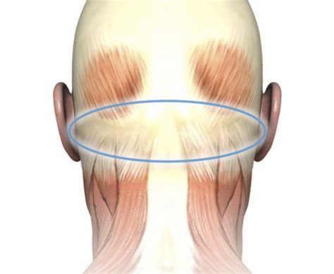 Greater Occipital Nerve Block Effective For Acute Relief Of Refractory