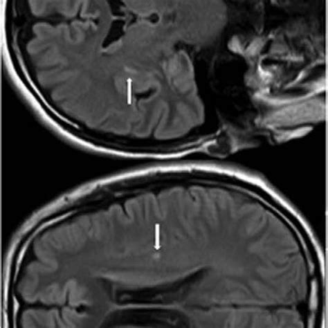 Brain Mri Results Of The Patient On Admission Brain Mri Axial Flair