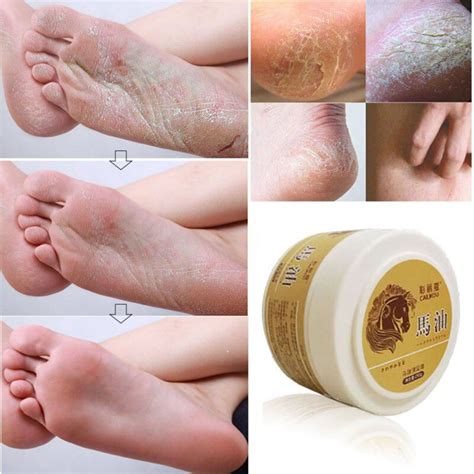 Cracked Heel Cream Dry Feet Remove Dead Skin Foot Repair Ml Aliexpress