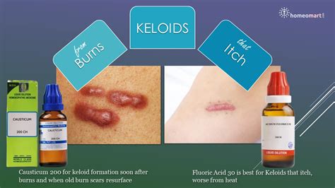 Keloids Treatment In Homeopathy Natural Scar Solutions