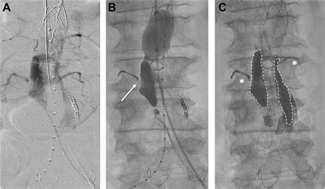 Endovascular Aortic Aneurysm Repair Without Type 2 Endoleak Using