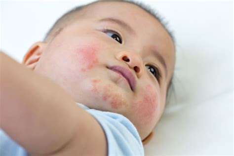 Baby Rash On Face Allergy