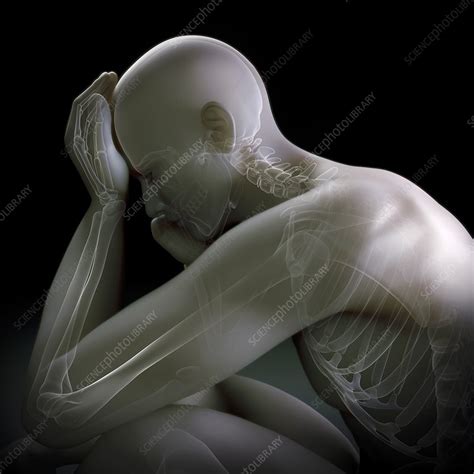 Depression Artwork Stock Image C0202054 Science